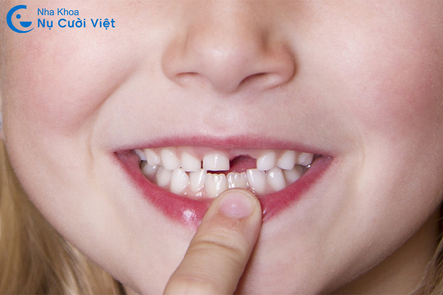 Nụ Cười Việt - Trẻ 14 tuổi trồng răng Implant được không? Phương pháp thay thế hiệu quả là gì?