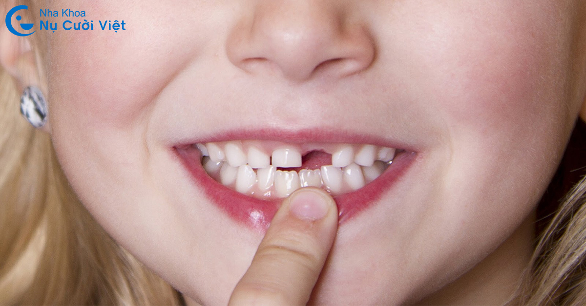 14 tuổi trồng răng implant được không