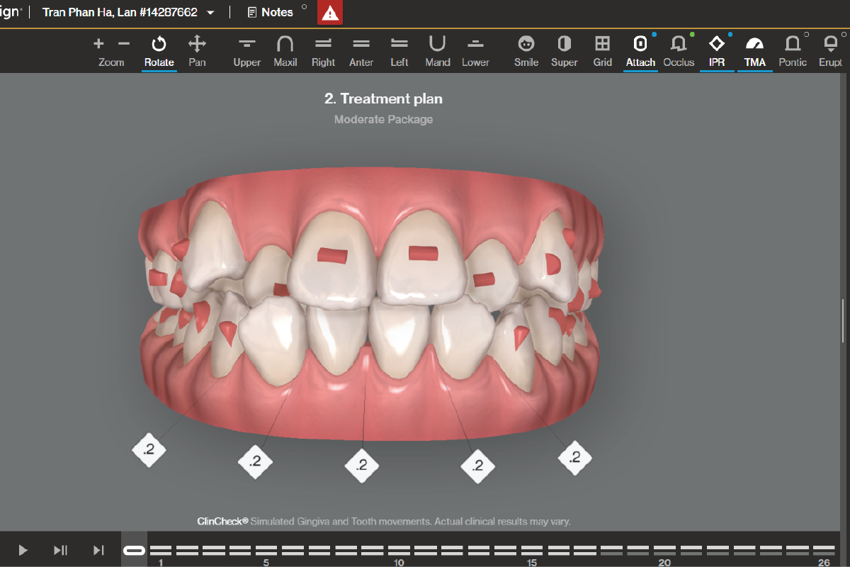 Clincheck Invisalign PHẦN MỀM CLINCHECK TRONG NIỀNG RĂNG INVISALIGN LÀ GÌ?