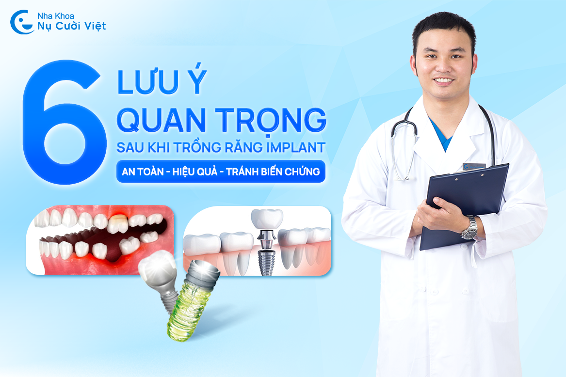 Nụ Cười Việt - 6 LƯU Ý CHĂM SÓC SAU KHI TRỒNG RĂNG IMPLANT AN TOÀN, HIỆU QUẢ, TRÁNH BIẾN CHỨNG