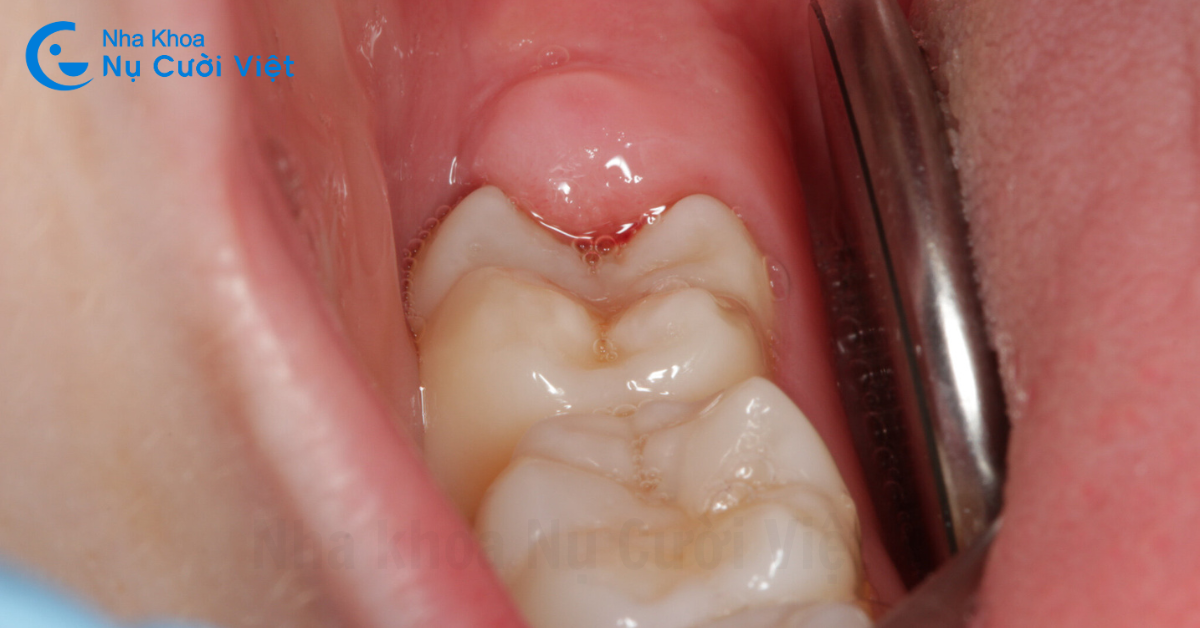 ảnh hưởng của răng khôn đến sức khỏe răng miệng