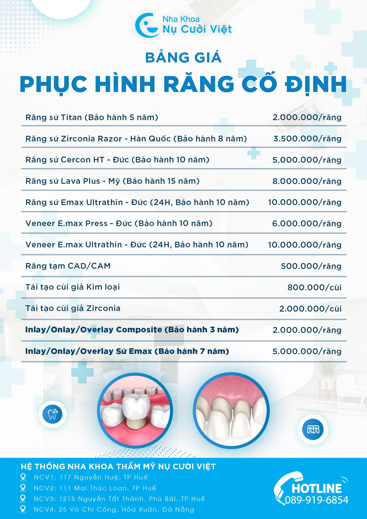 bảng giá dán sứ nụ cười việt
