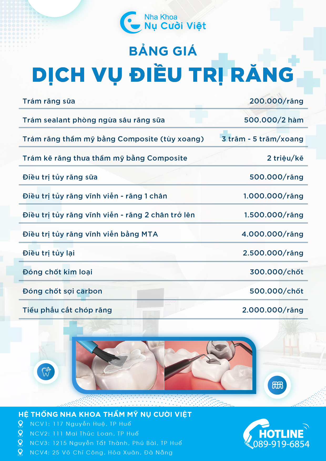 bảng giá trám răng chi tiết tại nụ cười việt