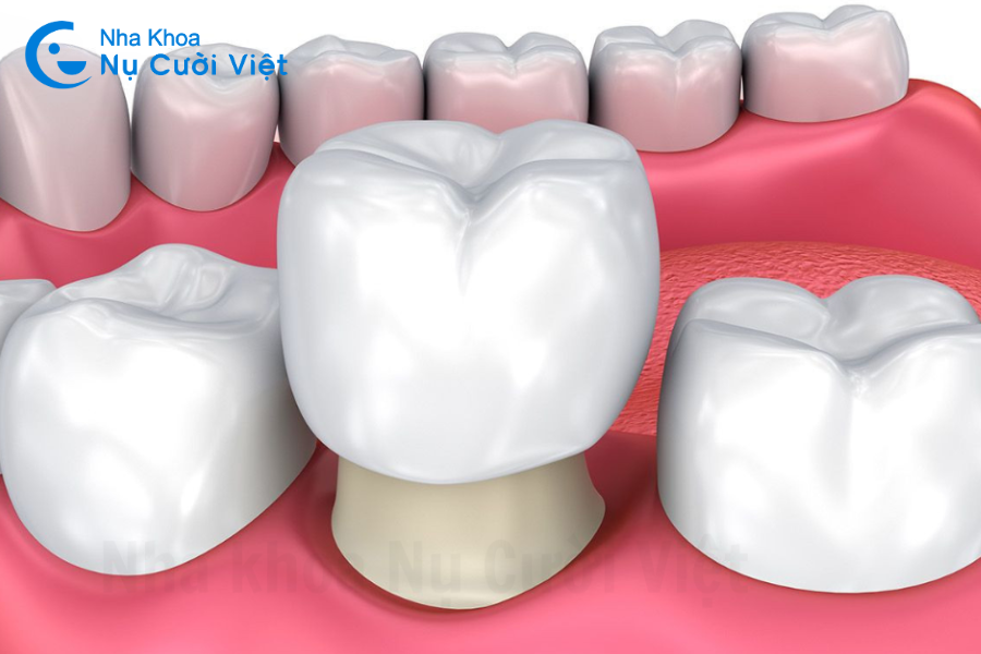 Nụ Cười Việt - Bọc răng sứ có tốt không: Những điều nhất định phải biết trước khi bọc răng sứ