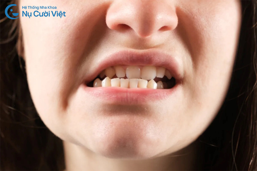 Nụ Cười Việt - Bọc răng sứ có hết móm không? Giải pháp nào điều trị móm tối ưu?