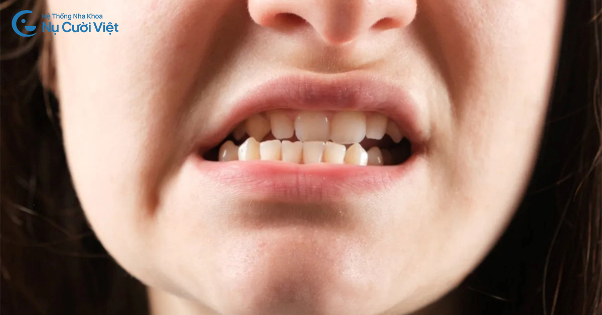 bọc răng sứ có hết móm không