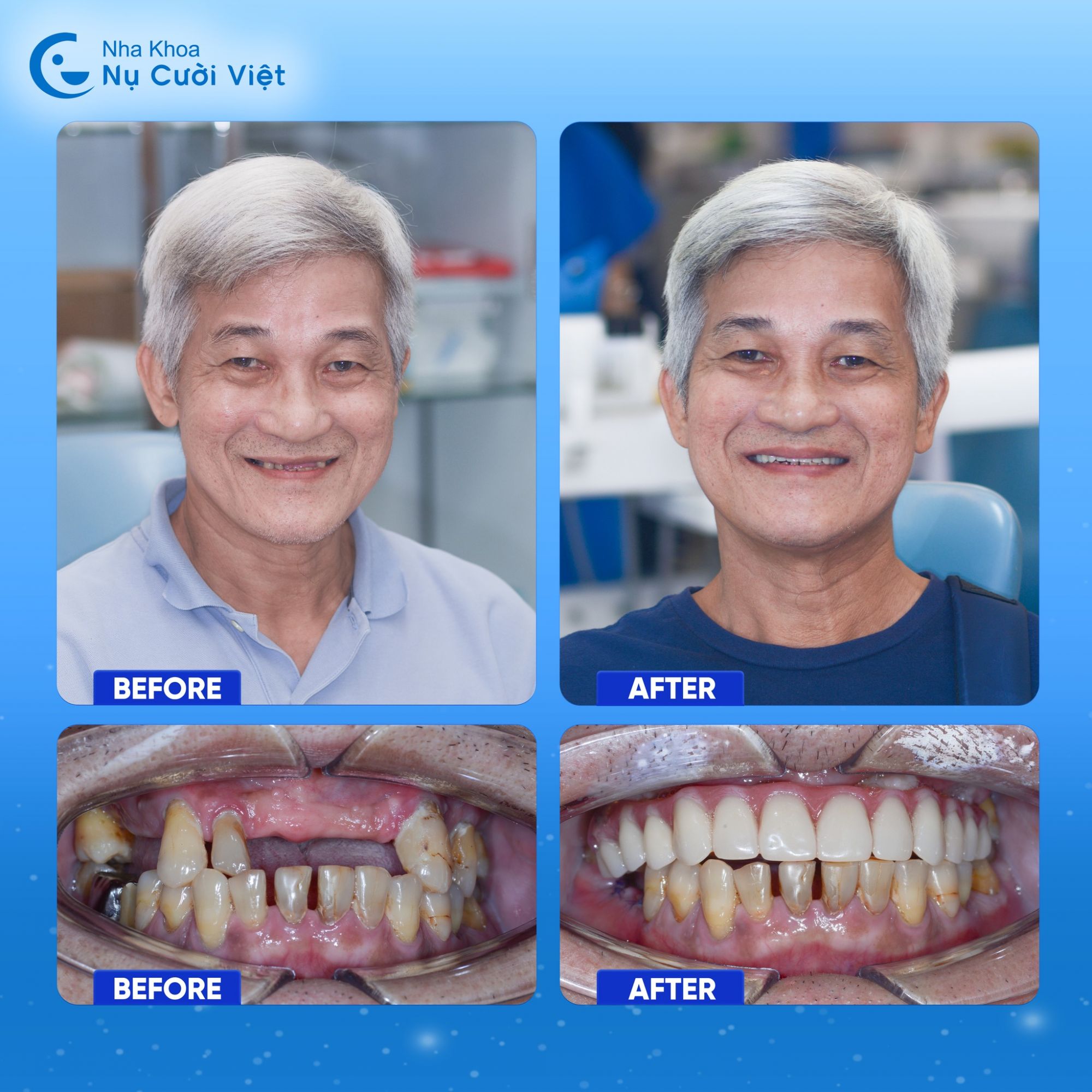ca điều trị mất răng lâu năm 2