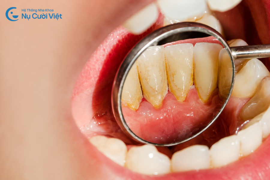 Nụ Cười Việt - Cao răng tự tróc được không? Khi nào nên lấy cao răng?
