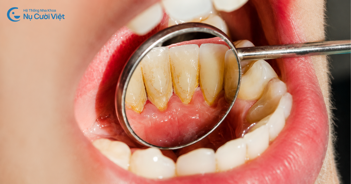 cao răng có tự bong tróc không