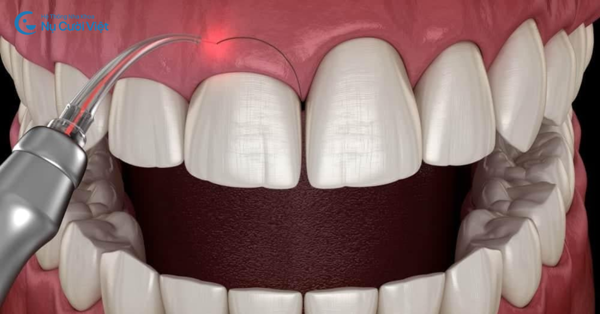 cắt lợi bằng laser có đau không