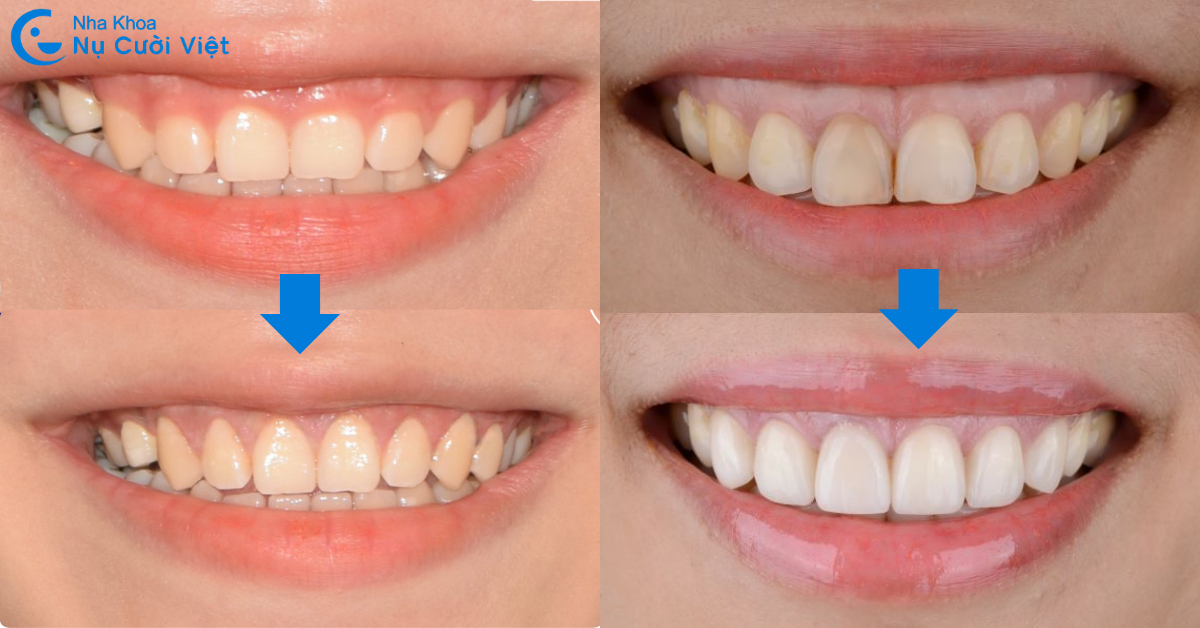 cắt nướu trị cười hở lợi