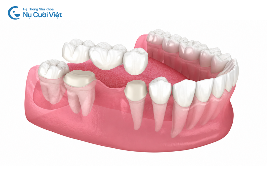 Nụ Cười Việt - Làm cầu răng sứ có đau không, độ bền như thế nào? 