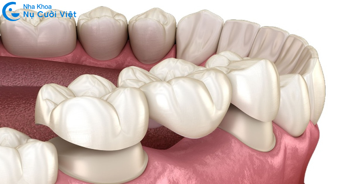 cầu răng sứ răng số 7