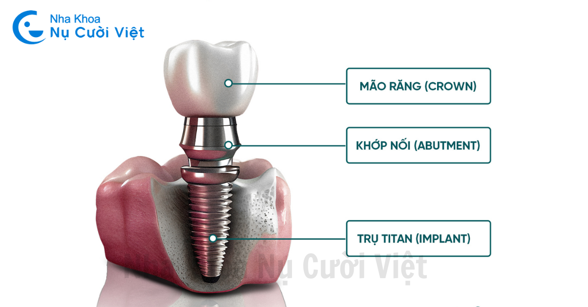 cấu tạo của răng implant