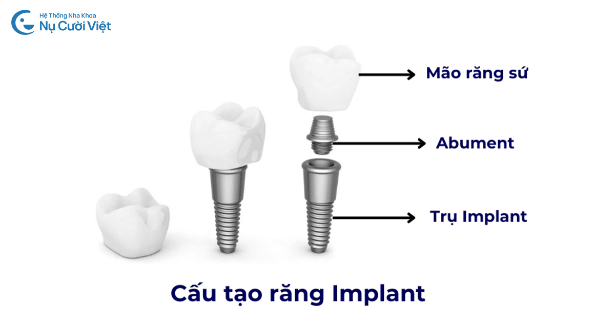 cấu tạo trụ implant