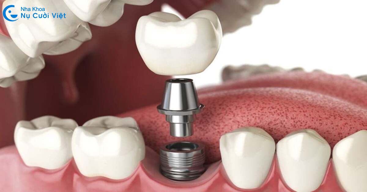người bị tiểu đường vẫn có thể trồng implant được