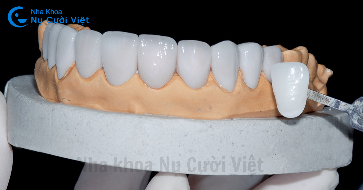 chất liệu mặt dán sứ veneer cao cấp