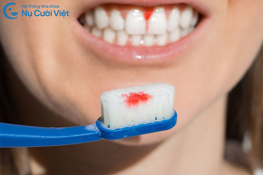 Nụ Cười Việt - Thường xuyên chảy máu chân răng khi đánh răng có nguy hiểm không?