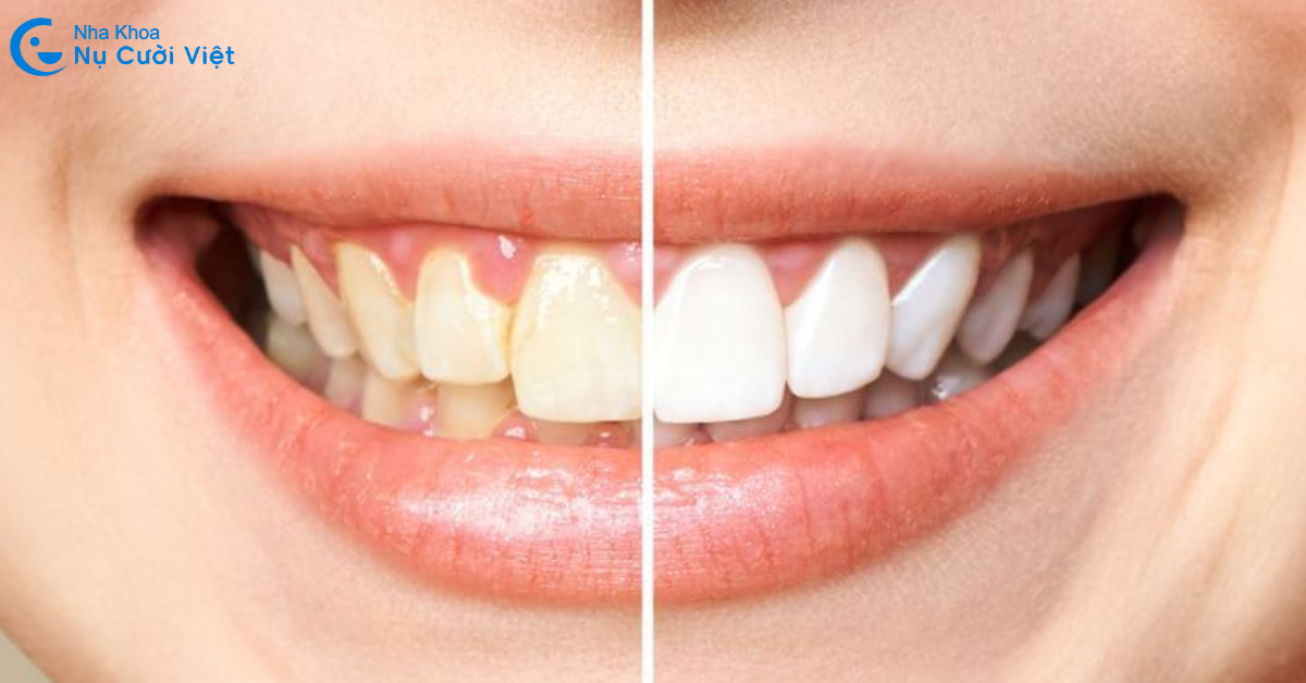 tẩy trắng răng khắc phục răng nhiễm màu