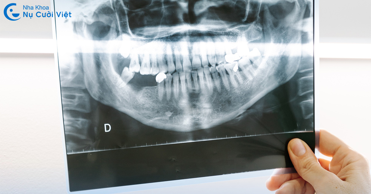 lưu ý cần trước khi cấy ghép implant cho người bị loãng xương
