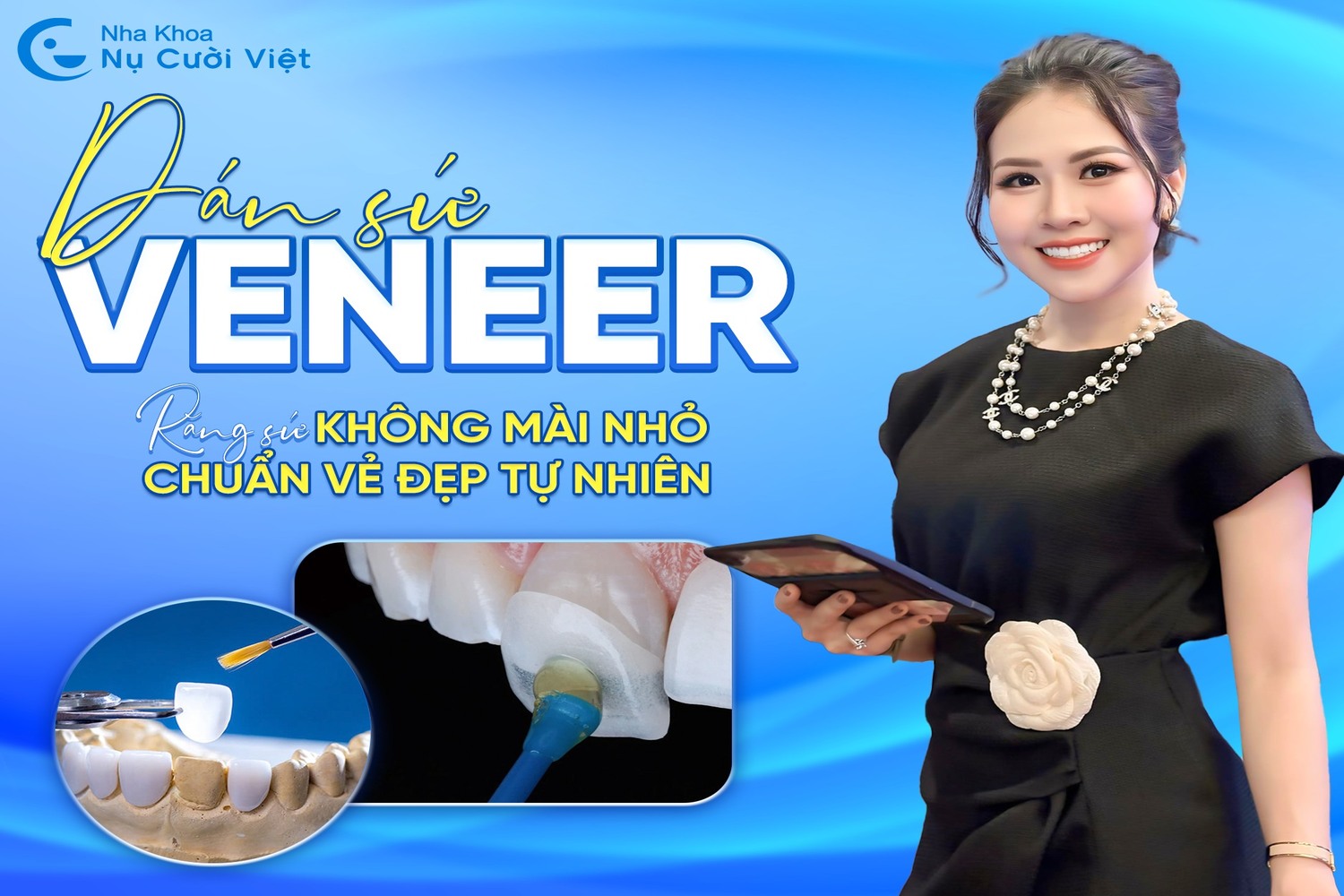 ưu điểm của dán sứ veneer