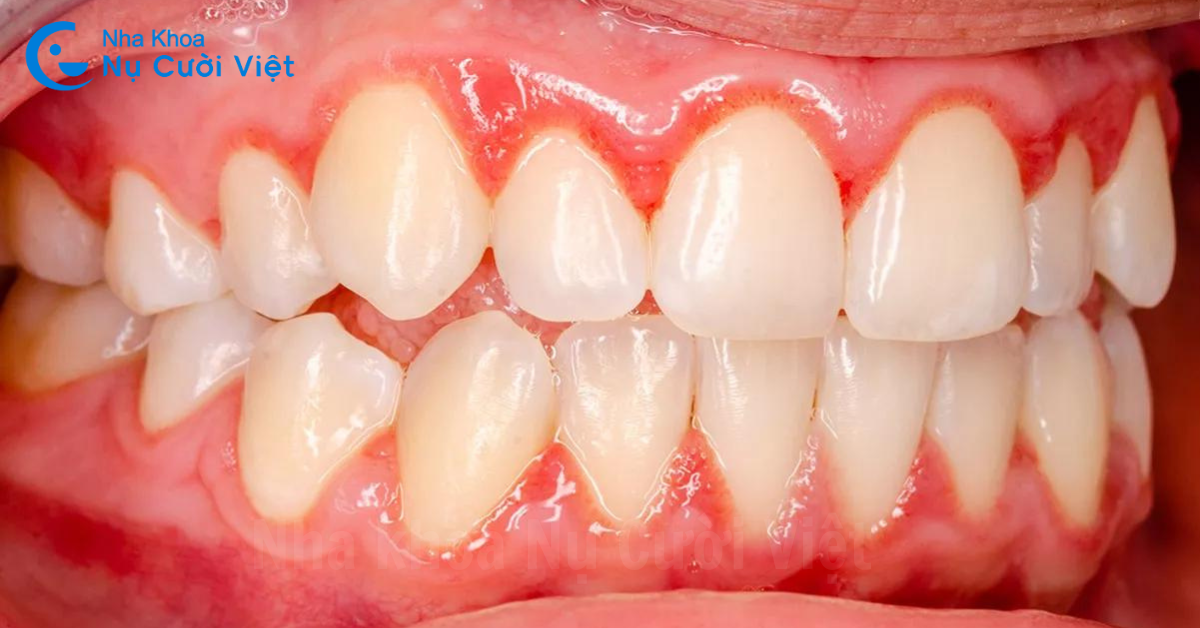 dấu hiệu nhận biết viêm nha chu
