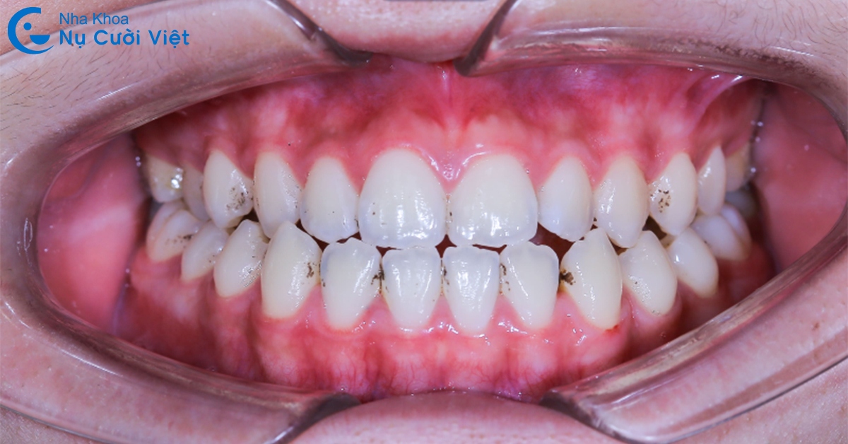 dấu hiệu của khớp cắn đối đầu