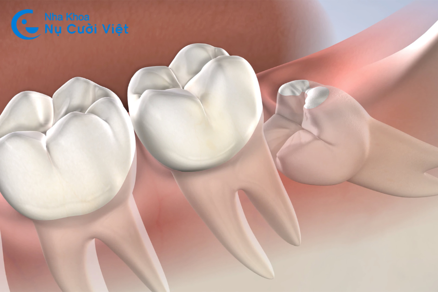 Nụ Cười Việt - 6 cách giảm đau răng khôn giảm đau nhanh cực kì hiệu quả 
