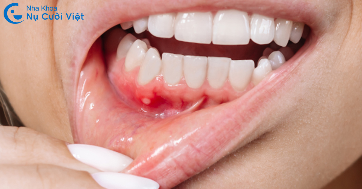 điều trị tụt lợi hở chân răng giai đoạn nhẹ