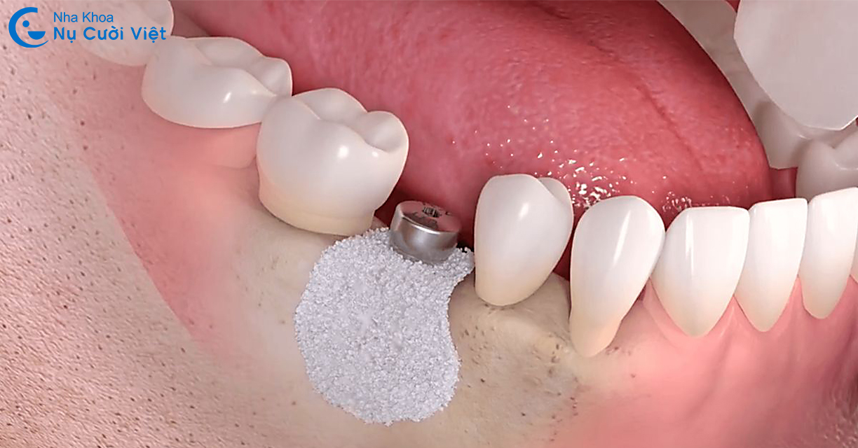 ghép xương tỏng cấy ghép implant