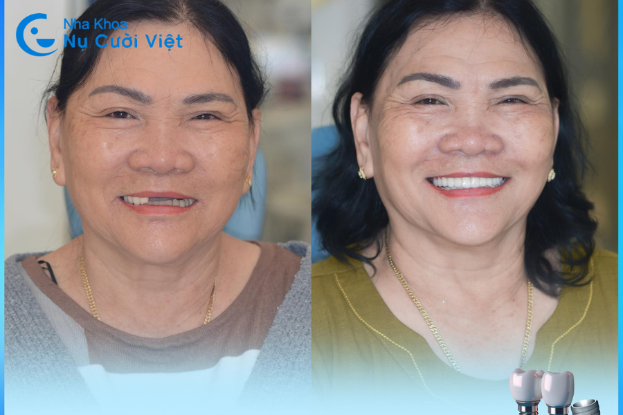 Nụ Cười Việt - Giá trồng răng Implant có cao không? Gợi ý cách giảm chi phí khi trồng răng Implant
