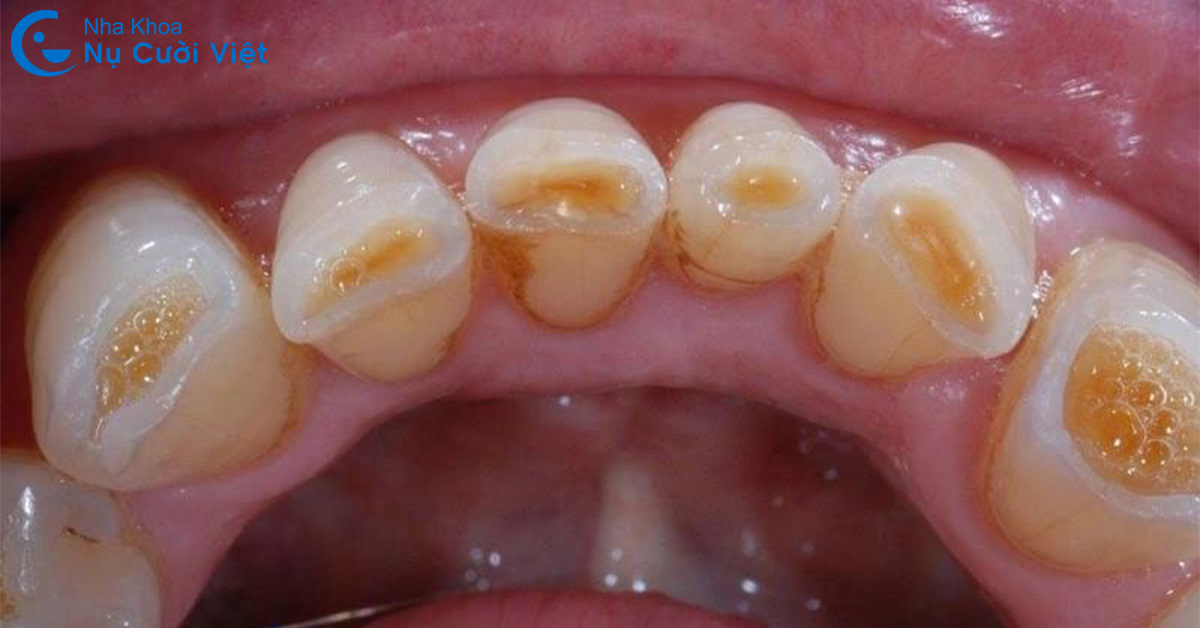 khớp cắn đối đầu gây mòn răng