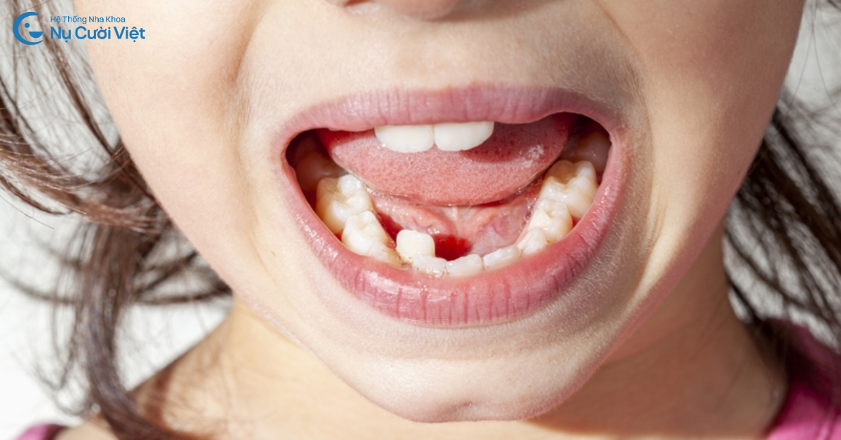 hậu quả răng mọc lẫy ở trẻ