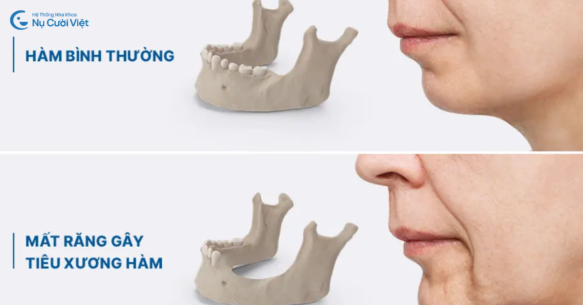 hậu quả nguyên nhân tiêu xương hàm