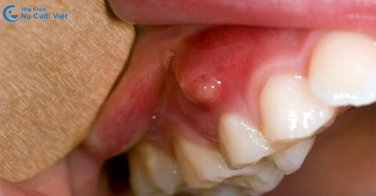 viêm tủy gây nên những hậu quả nghiêm trọng đến sức khỏe răng miệng