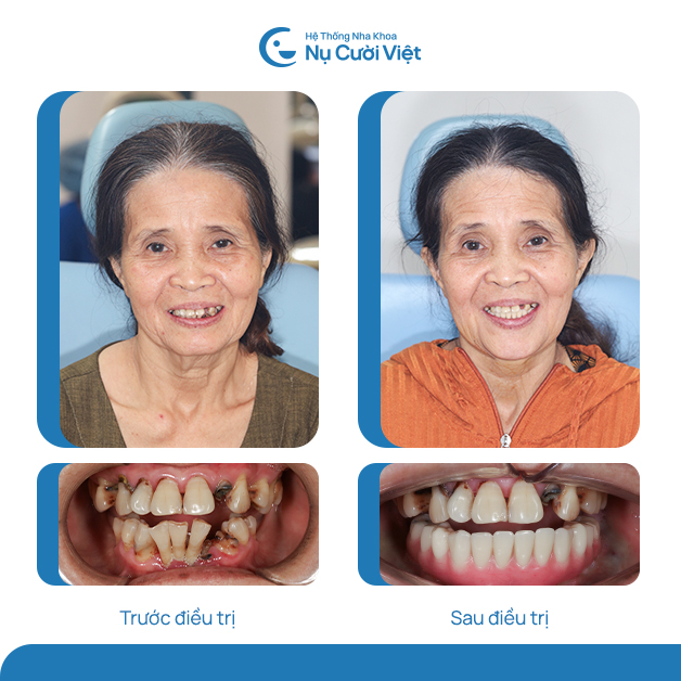kết quả trồng răng implant nha khoa nụ cười việt