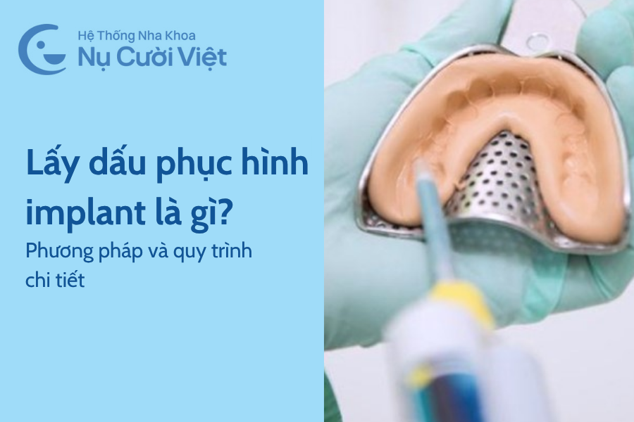 Nụ Cười Việt - Lấy dấu phục hình trên implant là gì? Phương pháp và quy trình 