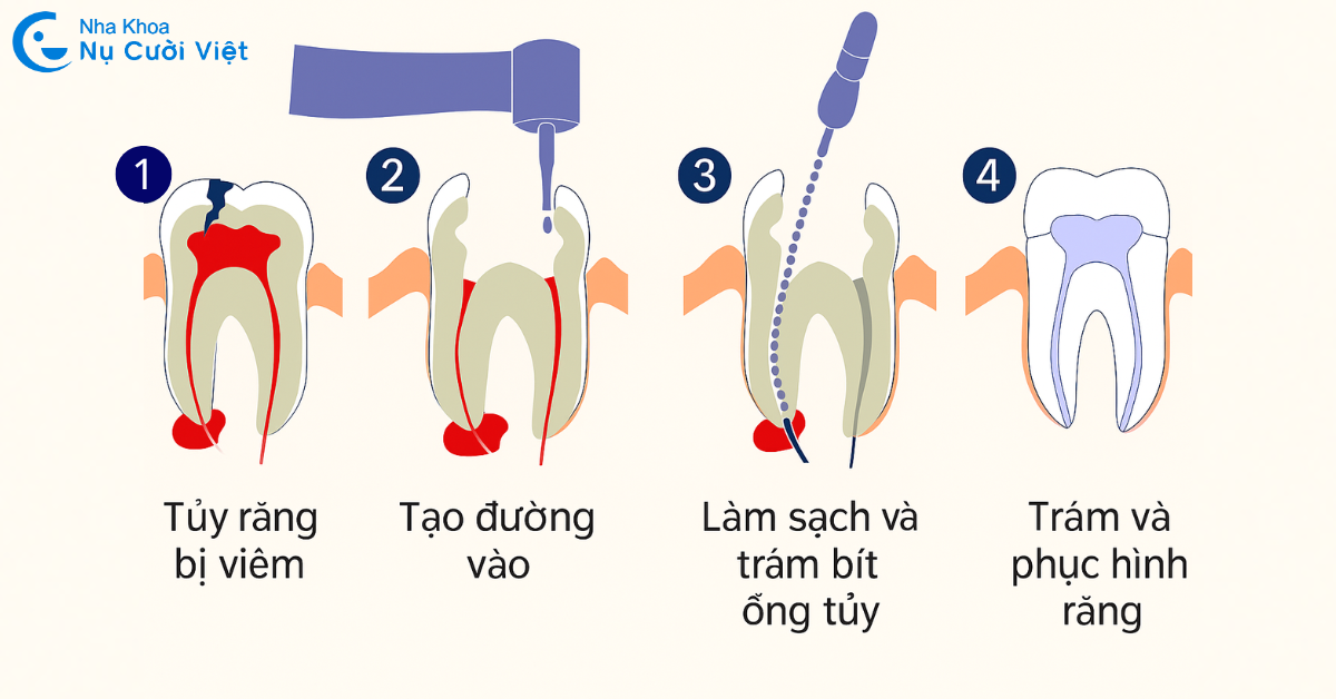 lấy tủy răng là gì tại sao cần kiêng sau khi lấy tủy