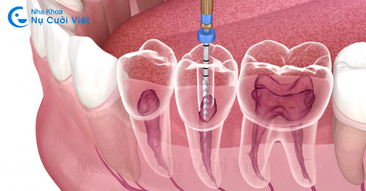 điều trị tủy răng
