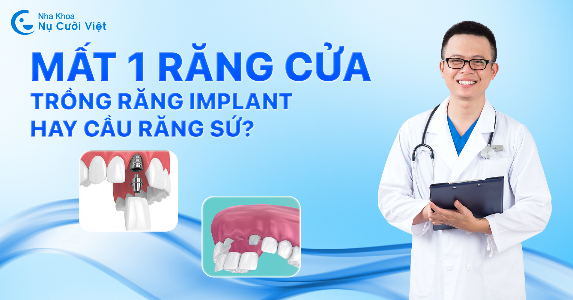 mất 1 răng cửa nên trồng implant hay cầu răng sứ