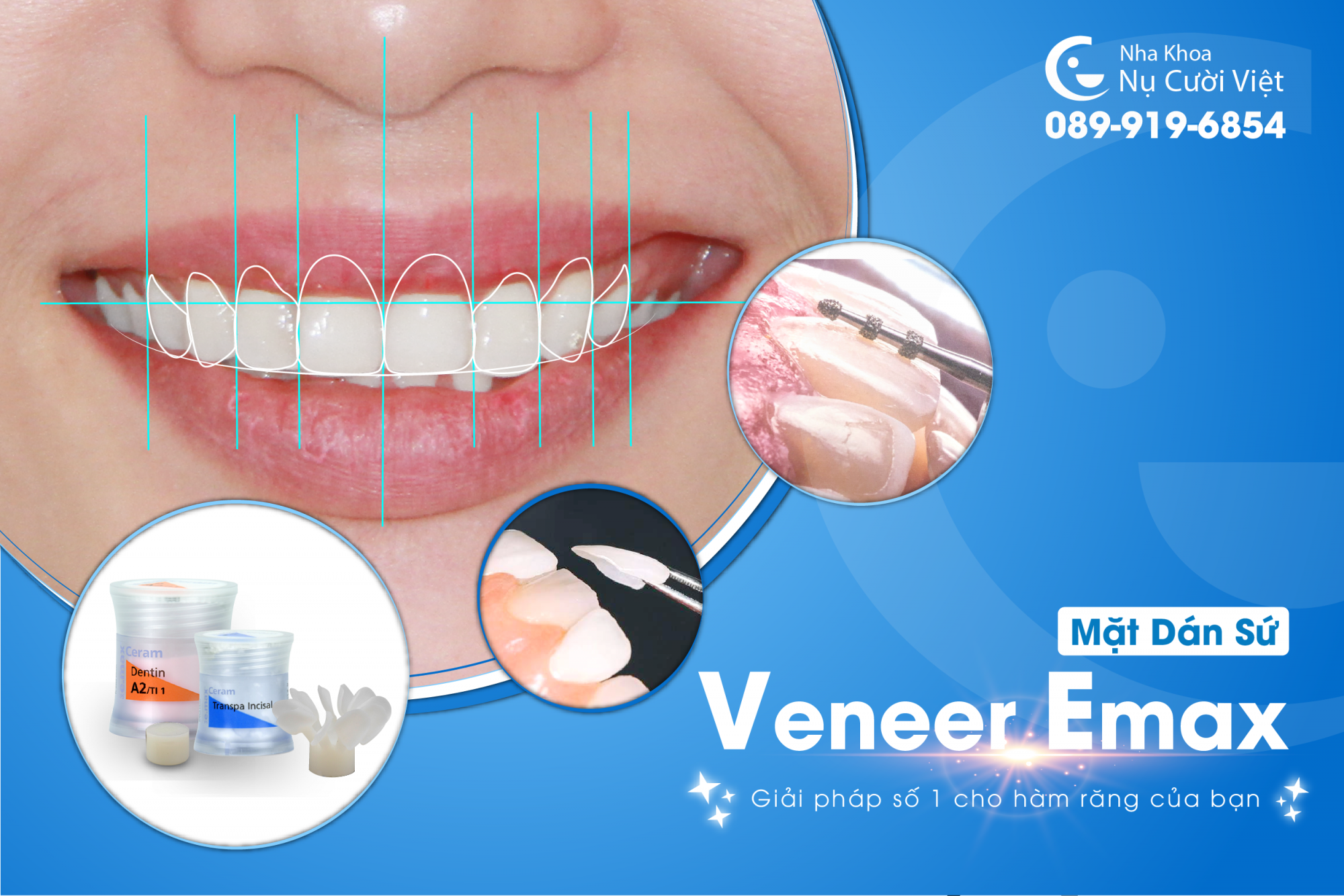 mặt dán sứ veneer là gì
