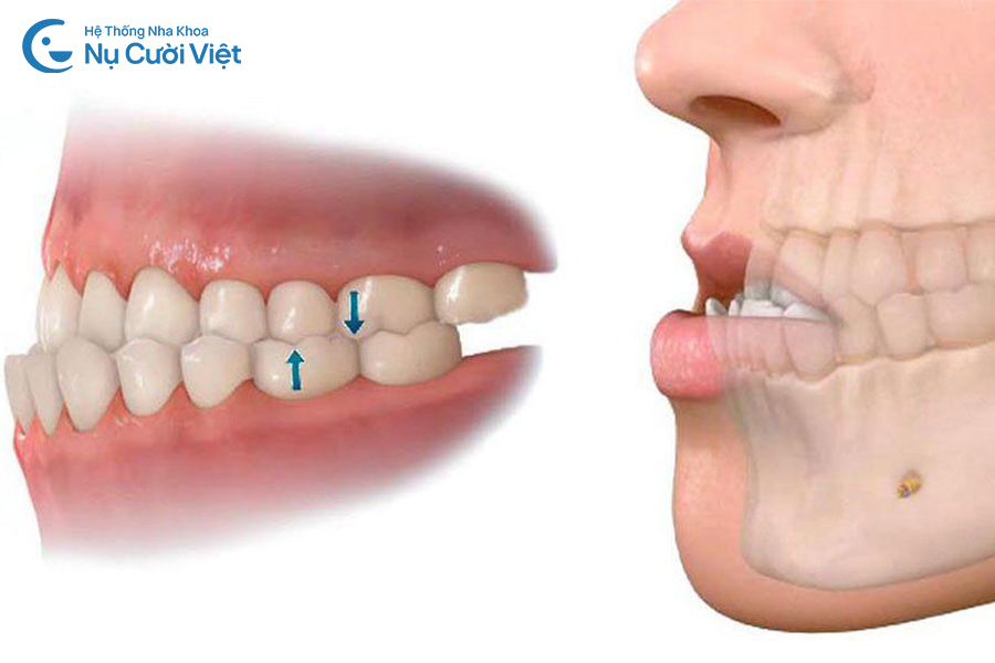 Nụ Cười Việt - Răng móm là gì? Nguyên nhân, dấu hiệu và cách khắc phục