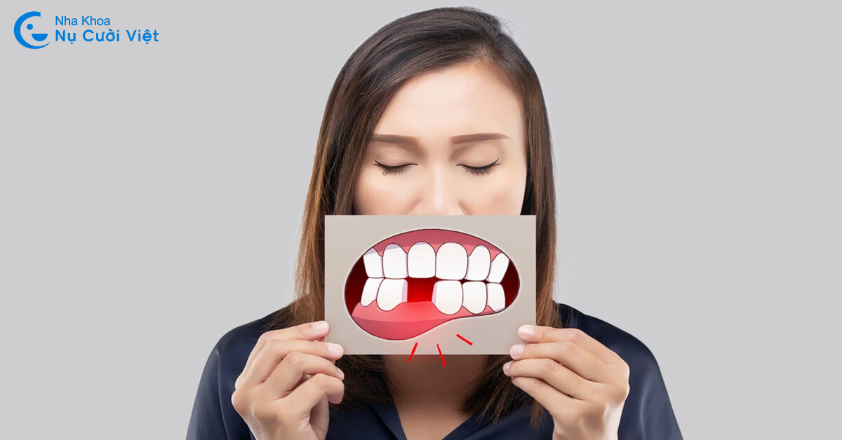người trẻ mất răng nụ cười việt