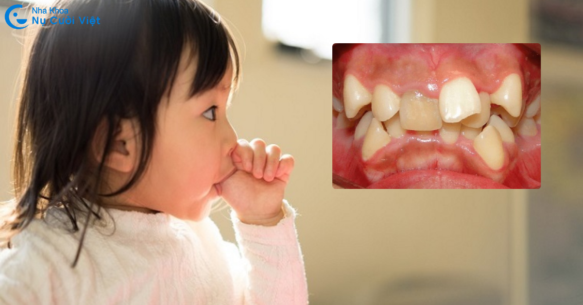 nguyên nhân khiến răng lộn xộn