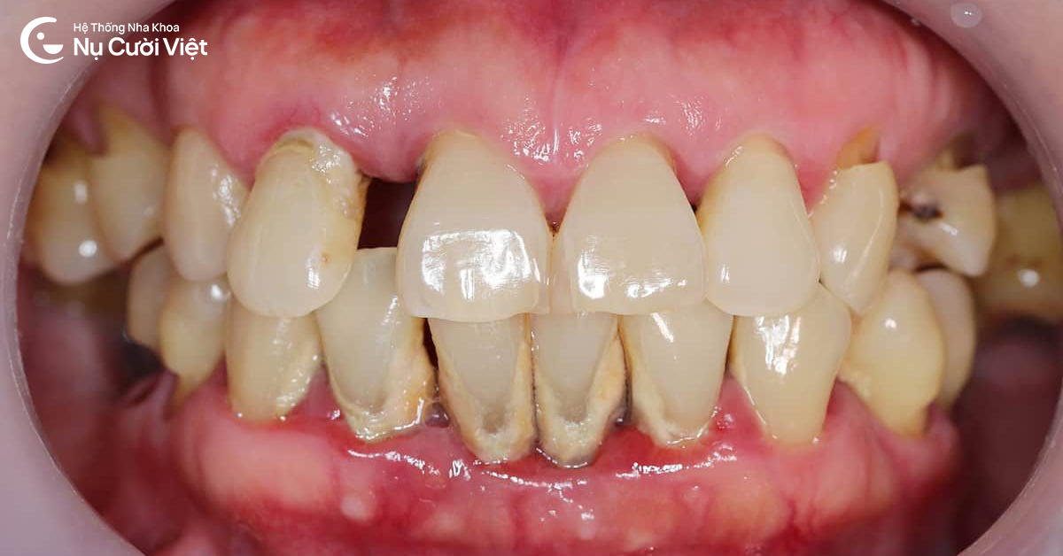 nguyên nhân mất răng do bệnh lý răng miệng