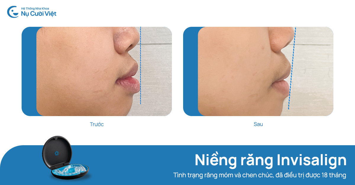 niềng răng khắc phục móm