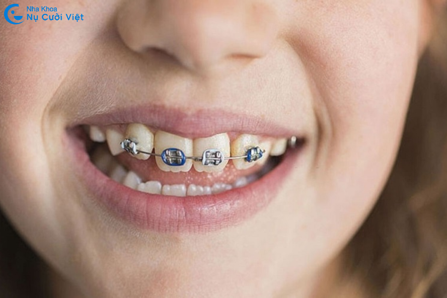 Nụ Cười Việt - CHỈ NIỀNG 2 RĂNG CỬA CÓ ĐƯỢC KHÔNG? NIỀNG BAO LÂU? NÊN CHỌN PHƯƠNG PHÁP NÀO?