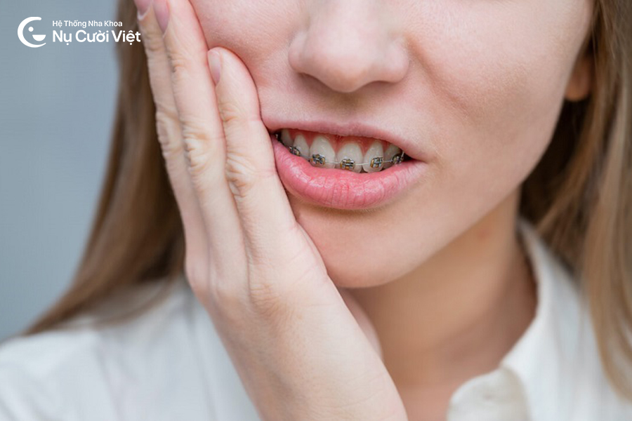 Nụ Cười Việt - Niềng răng có đau không? 4 giai đoạn đau khi niềng