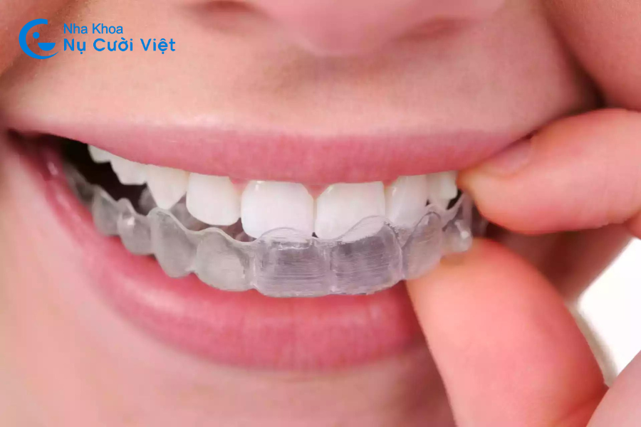 Nụ Cười Việt - Giải đáp thắc mắc về niềng răng Invisalign và hiệu quả của nó