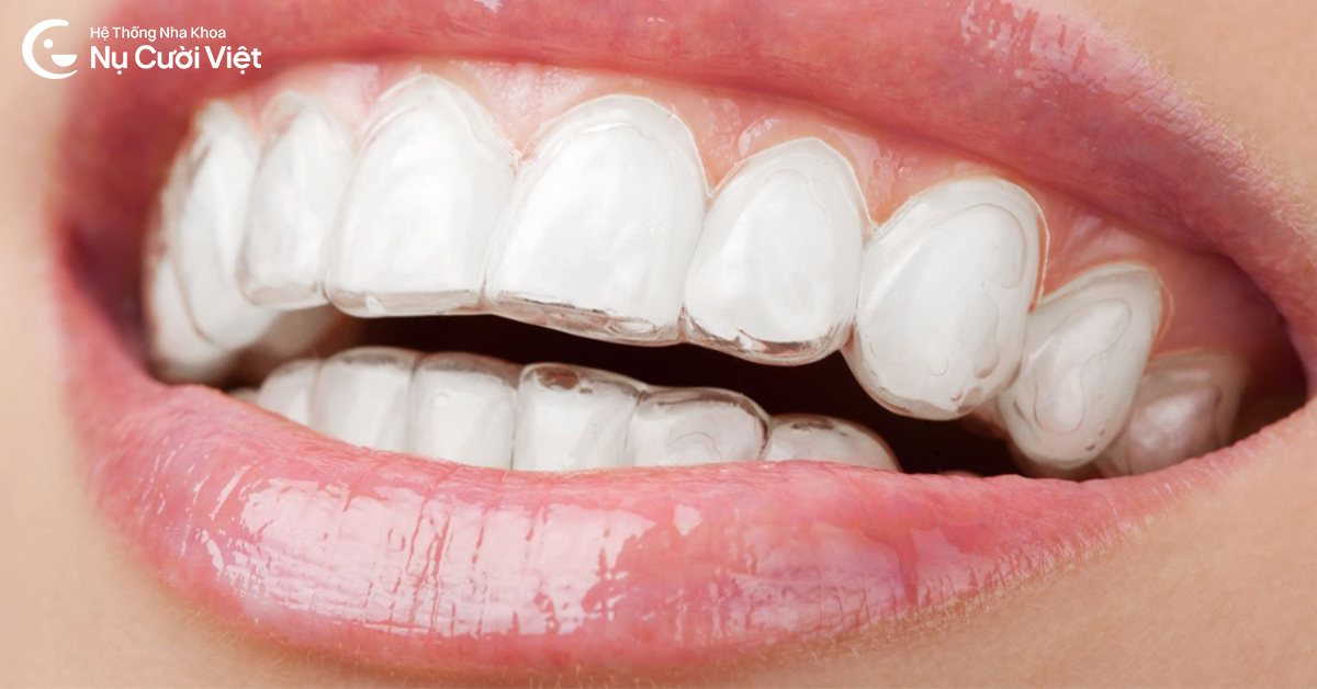 thời gian niềng invisalign mất bao lâu
